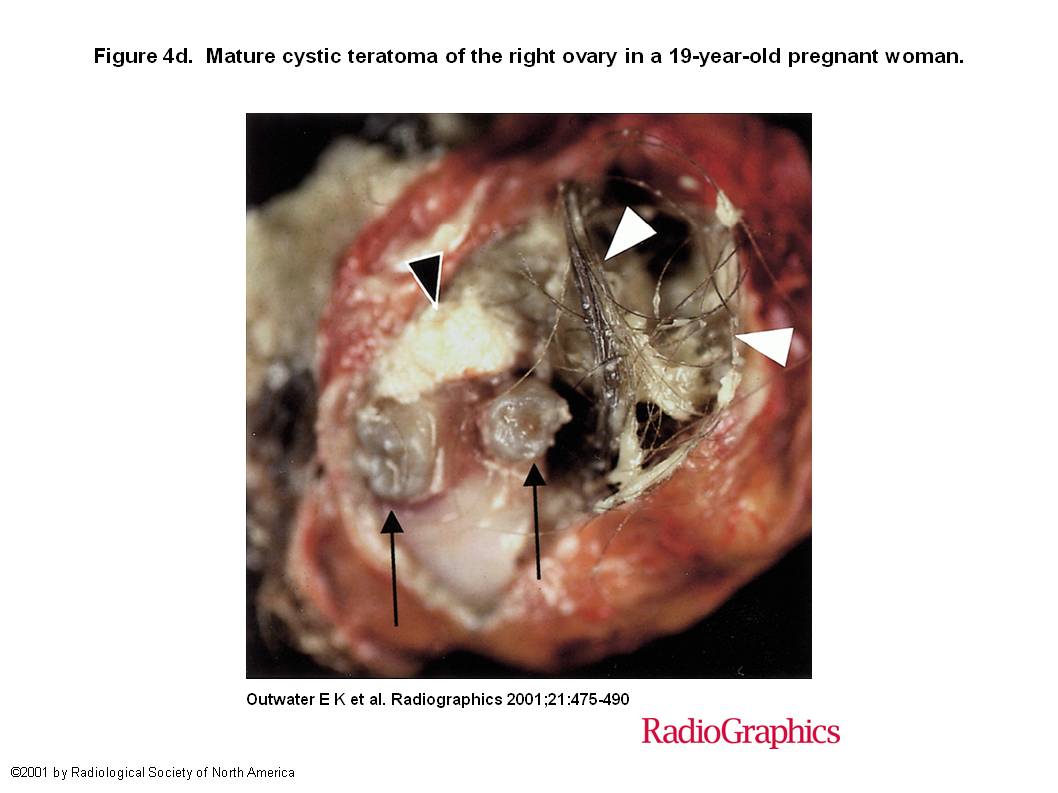 That would Teratoma ovarian cyst necessary words This Teratoma ovarian cyst well understand
